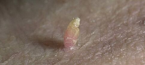 papilloma လိင်တံကိုဘယ်လိုဖယ်ရှားမလဲ