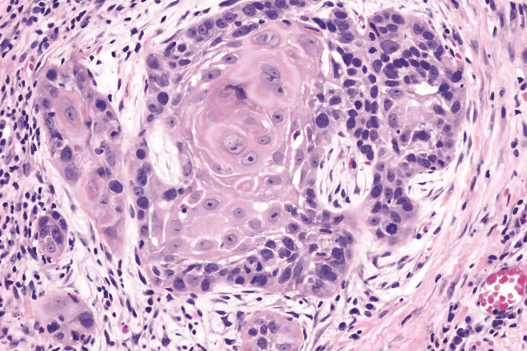 squamous cell papilloma ကုသမှု