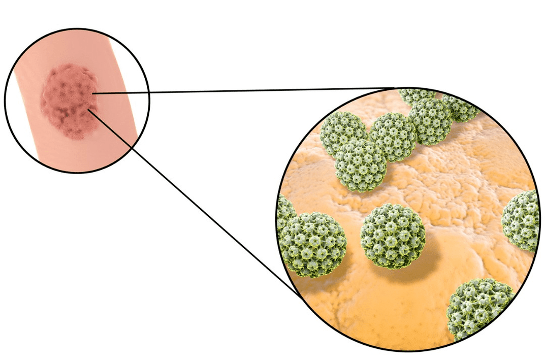 squamous cell papilloma ရောဂါပိုးကူးစက်မှု၏အရင်းအမြစ်